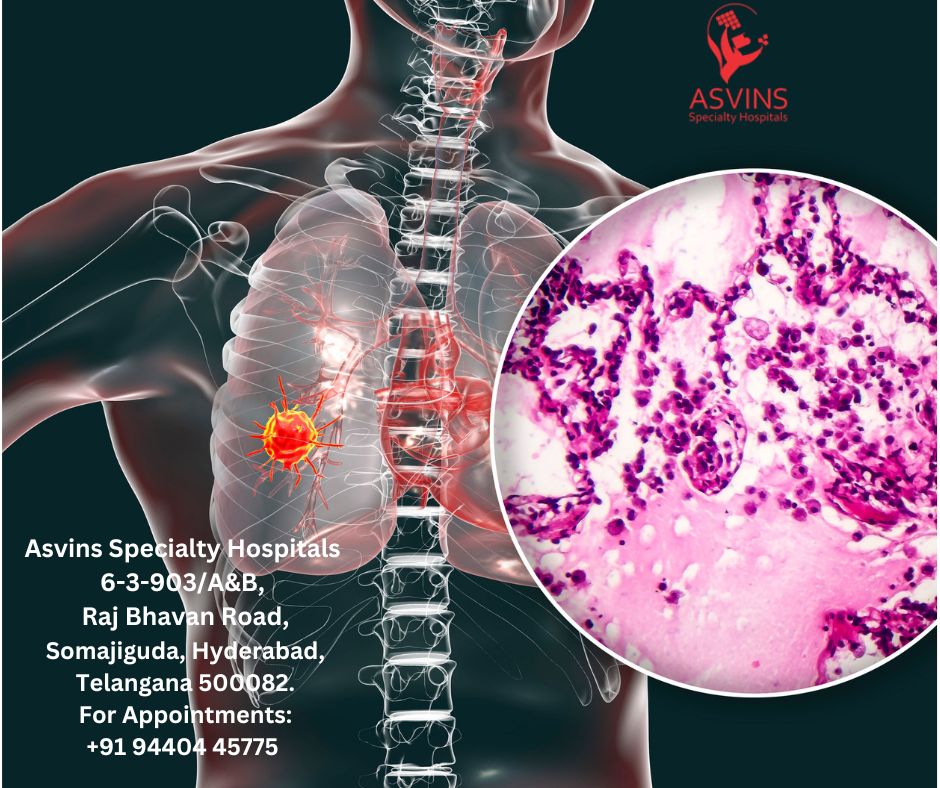 metastatic lung cancer
