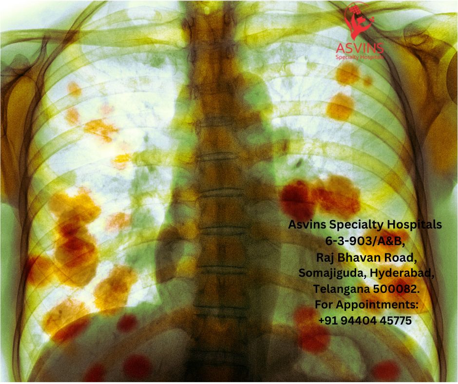non small cell lung cancer