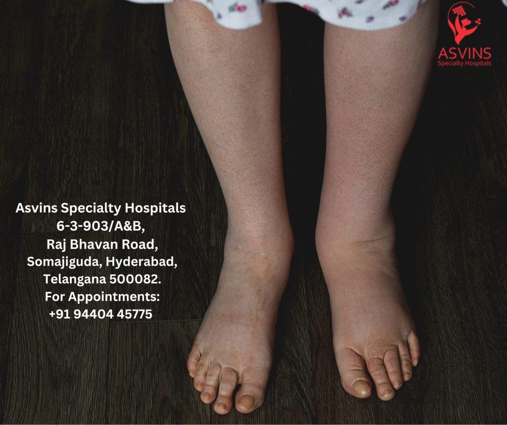 what is the role of a cancer treatment center in lymphedema management